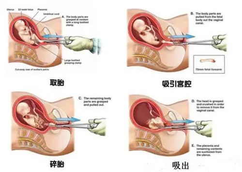 几个月适合做引产——关于孕期引产的一些常识