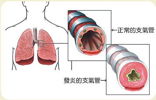 五个月宝宝的支气管炎，预防、诊断与治疗